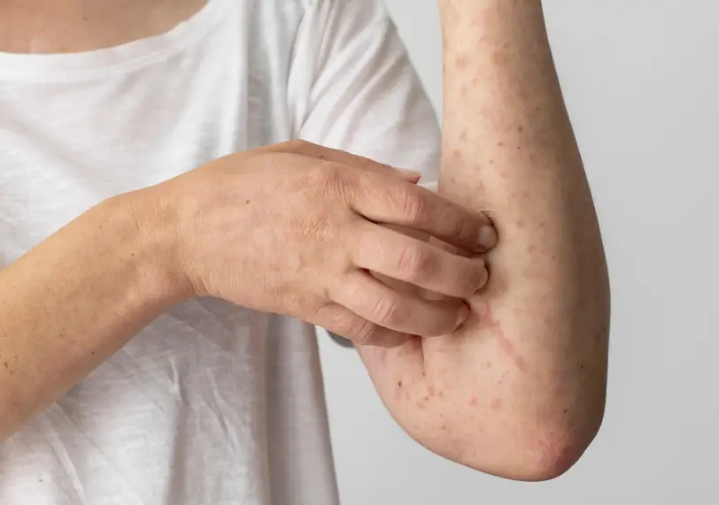 Skin Diseases